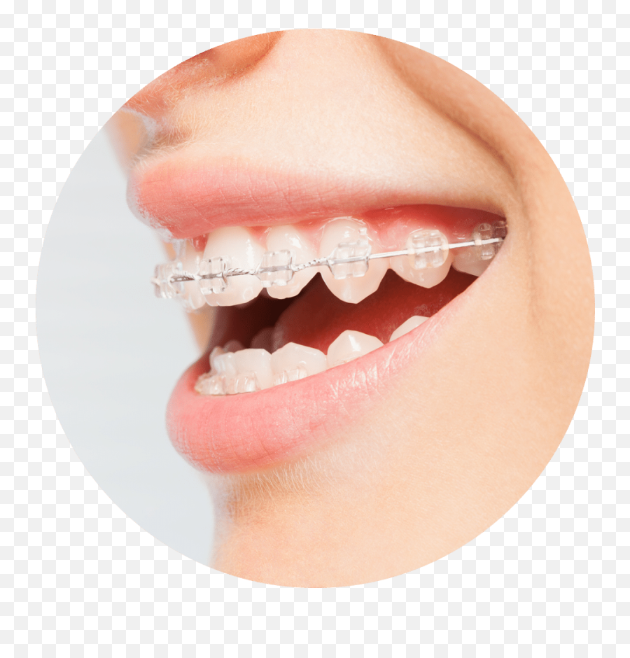 Types Of Treatments Pezoldt Orthodontics Emoji,Different Types Of Facial Emotions