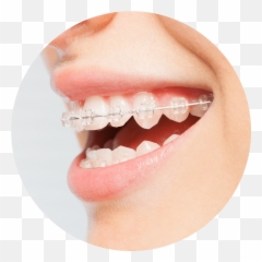 Types Of Treatments Pezoldt Orthodontics Emoji,Different Types Of Facial Emotions