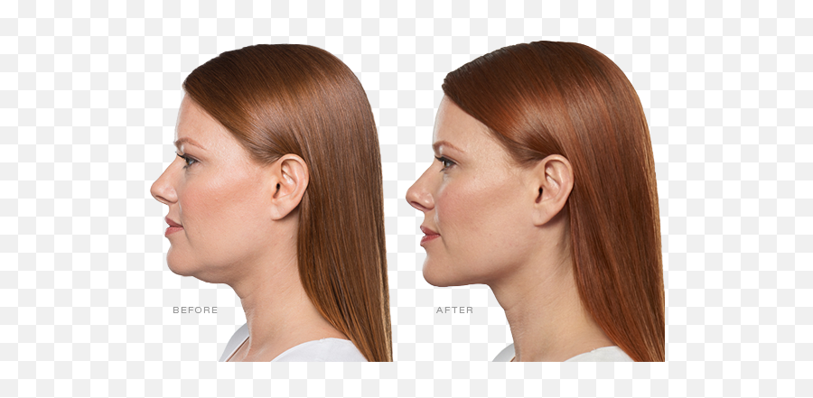 Minimally Invasive Procedures - Double Chin Removal Emoji,Botox On Emotion