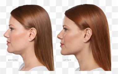Minimally Invasive Procedures - Double Chin Removal Emoji,Botox On Emotion