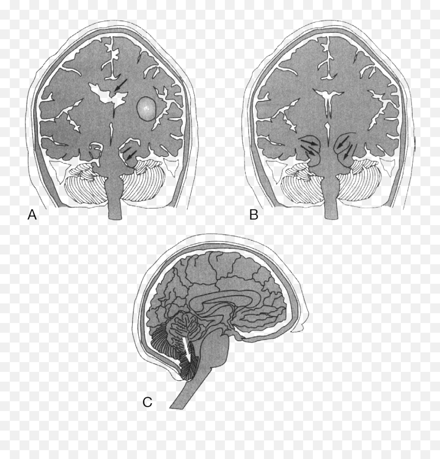 Neurologic System Springer Publishing - Dot Emoji,Surgery Cut Open Brain And No Emotion