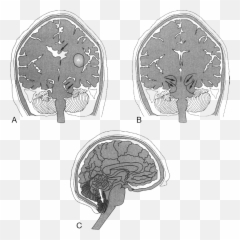 Neurologic System Springer Publishing - Dot Emoji,Surgery Cut Open Brain And No Emotion