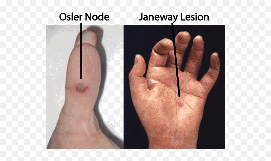 The Hand Examination Stanford Medicine 25 Stanford Medicine - Janeway Lesions Emoji,Heavy Metal Fingers Emoticon Facebook