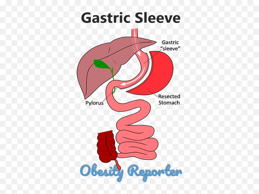 Gastric Sleeve Surgery Comprehensive Guide 2021 - Vertical Emoji,Surgery Cut Open Brain And No Emotion