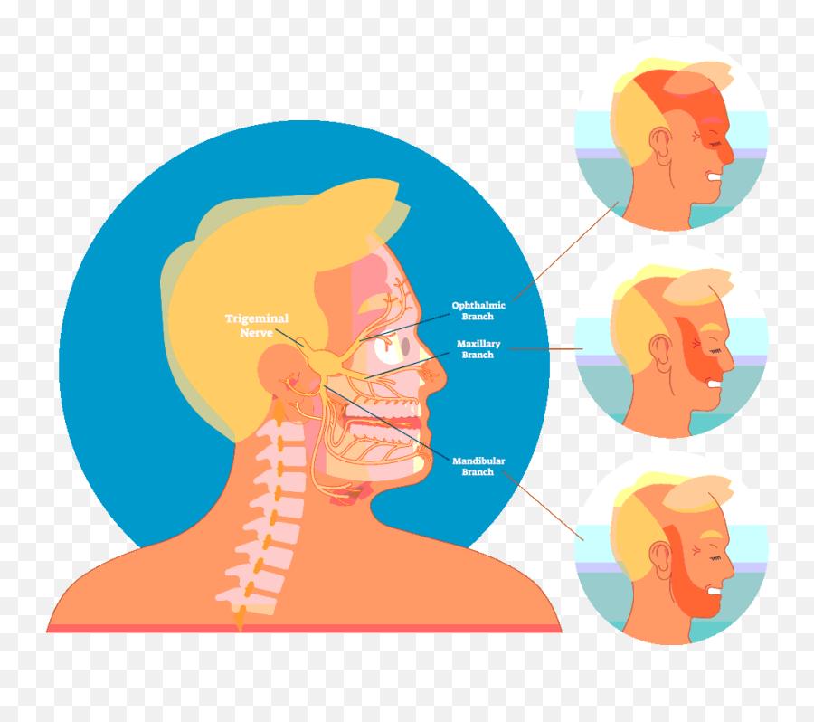 Trigeminal Neuralgia Altair Health Emoji,Surgery Cut Open Brain And No Emotion