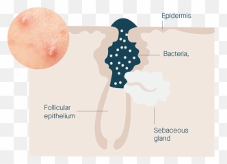 Sensitive Skin Acne System - Dot Emoji,Pimple Emoji