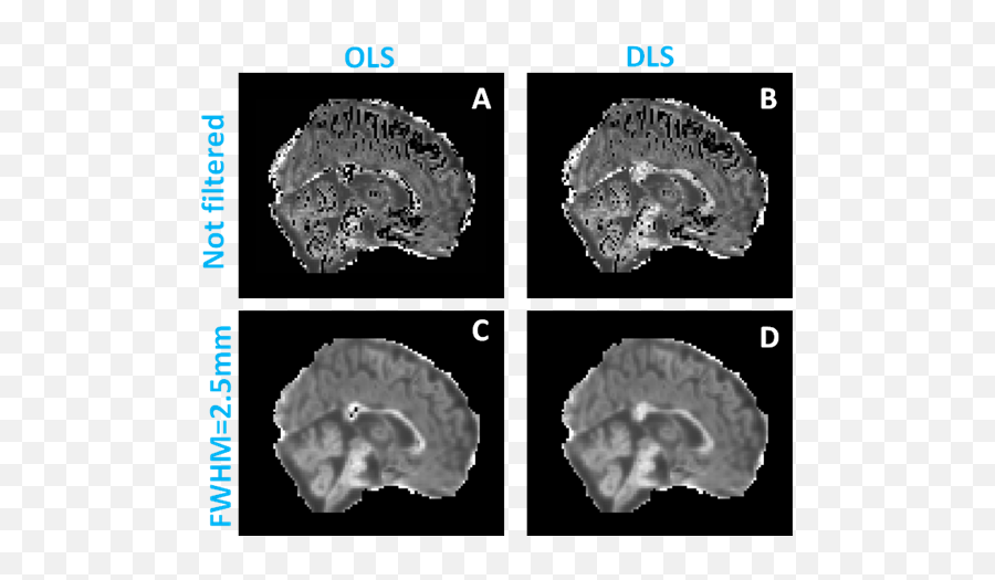 Cam - Stroke Cerebral Mri Proton Density Emoji,Feer Emotion Mri