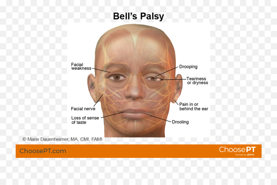 Guide Physical Therapy Guide To Bellu0027s Palsy Choose Pt Emoji,Different Types Of Facial Emotions