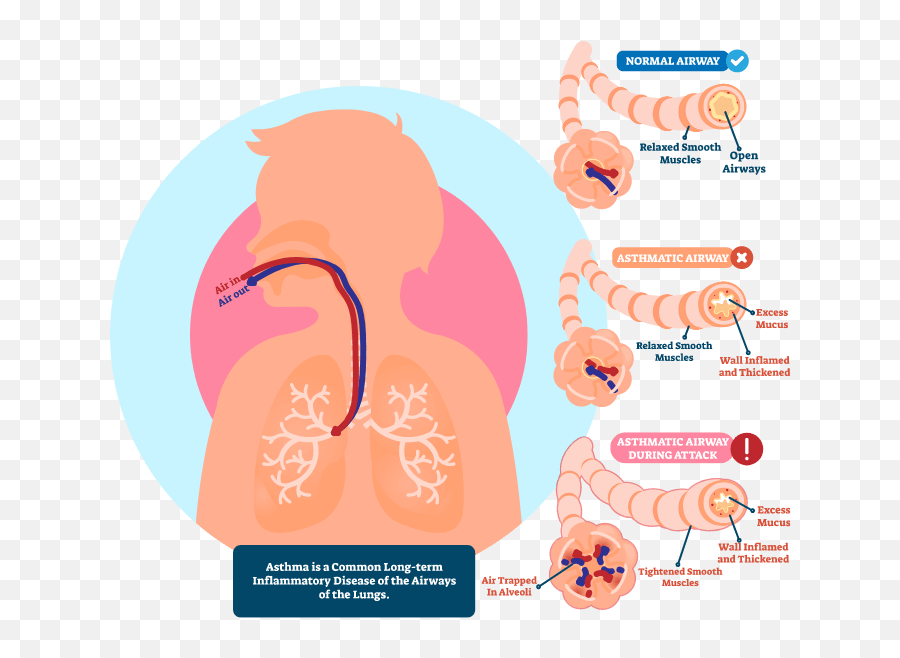 Treat - Language Emoji,9 Types Of Muscle Tension Caused By Trapped Emotions