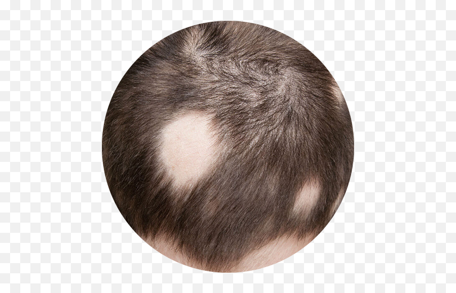 Patchy Hair Loss - Alopecia Areata Emoji,Emotions Associated With Hair Color