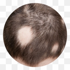 Patchy Hair Loss - Alopecia Areata Emoji,Emotions Associated With Hair Color