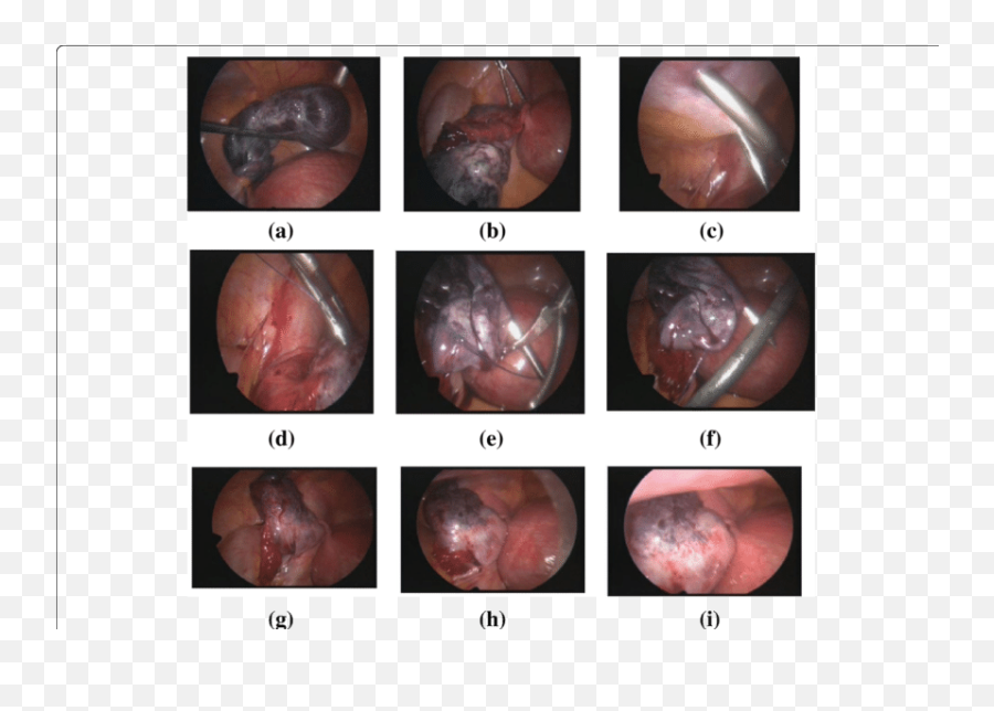 A Twisted Right Ovary B Detorsion C Site Of Entrance For Emoji,Chinese Emotion Ovaries