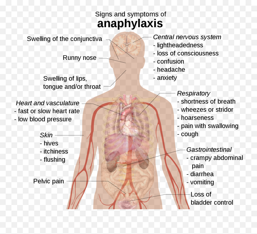 The Realities Of Living With Food Allergies The Dairy Free - Signs And Symptoms Of Anaphylaxis Emoji,Organ Emotions Anxiety