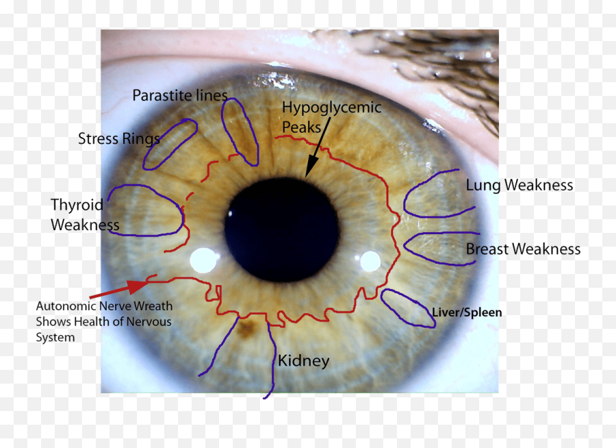 Iridology Chart Kidney - Cancer Iridology Emoji,Sthenic Emotions