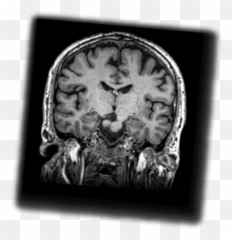 Schizophrenia And Mri Imaging - Computed Tomography Emoji,Schizophrenia & Emotions