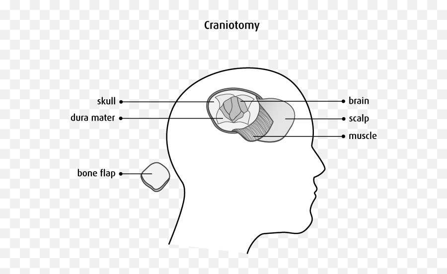 Surgery For Childhood Brain And Spinal Cord Tumours - Hair Design Emoji,Surgery Cut Open Brain And No Emotion