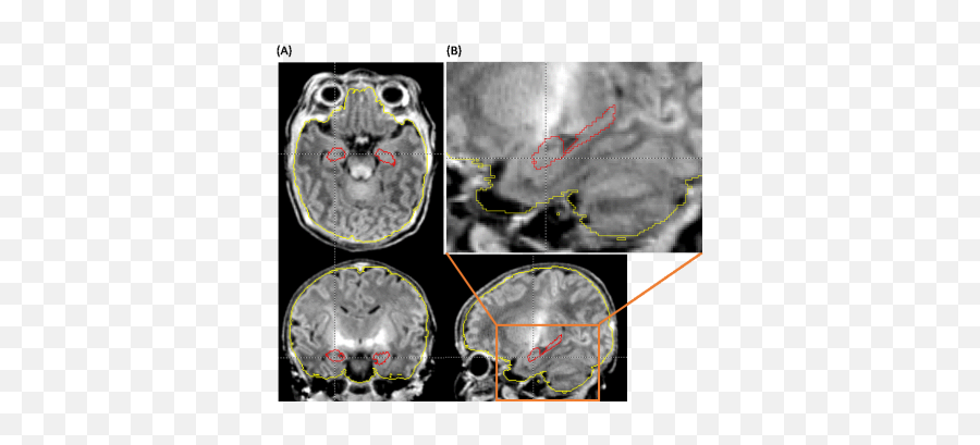 Ismrm19 Posters - Neuro Computed Tomography Emoji,Kathryn Dennis Monkey Emoji