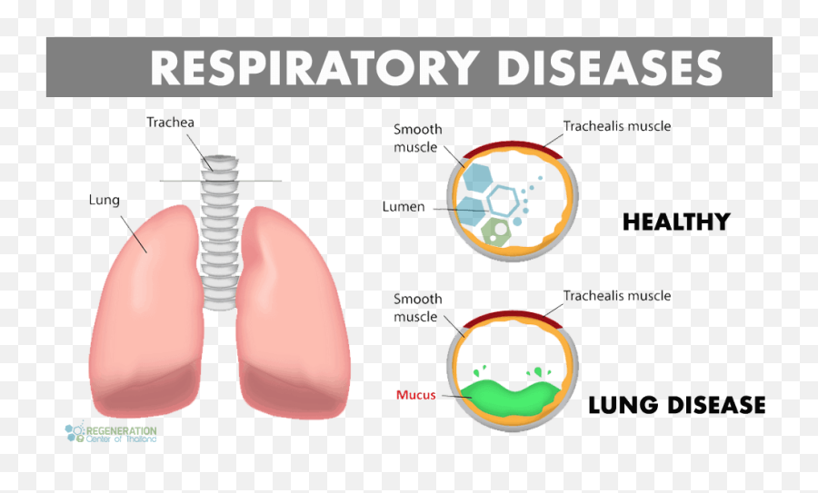 Is Lung Stem Cell Therapy For Copd Emphysema Effective - Cystic Fibrosis Illustration Emoji,Charcot Marie Tooth Emotions Reiki