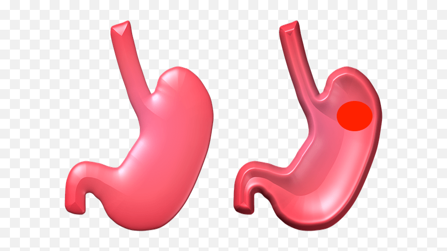 Dieta Para Úlcera De Estómago Recomendaciones Y Menús - Full Vs Empty Stomach Emoji,Emoticon Con Puntos Y Comas Y Parentesis