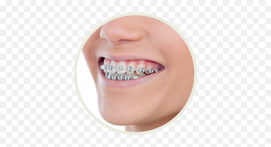 Color My Braces - Orthodontic Associates Ltd Flossmoor Color Band White Braces Emoji,Emoticons With Braces On Teeth