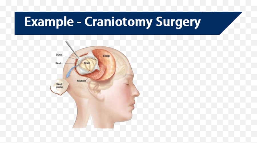 Craniotomy Brain Tumor Surgery Cost In India - Craniotomy Surgery Emoji,Surgery Cut Open Brain And No Emotion