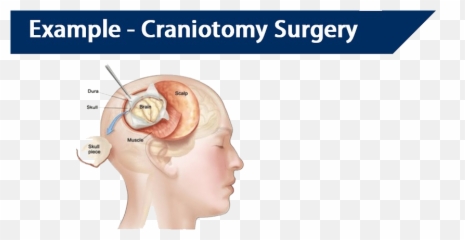 Craniotomy Brain Tumor Surgery Cost In India - Craniotomy Surgery Emoji,Surgery Cut Open Brain And No Emotion