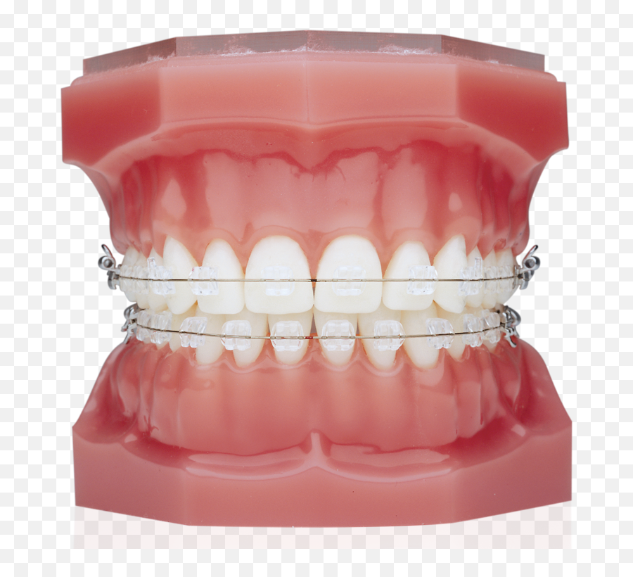 Braces U2014 Douglas Nguyen Orthodontics - Braces Without Brackets Emoji,Emoticons With Braces On Teeth