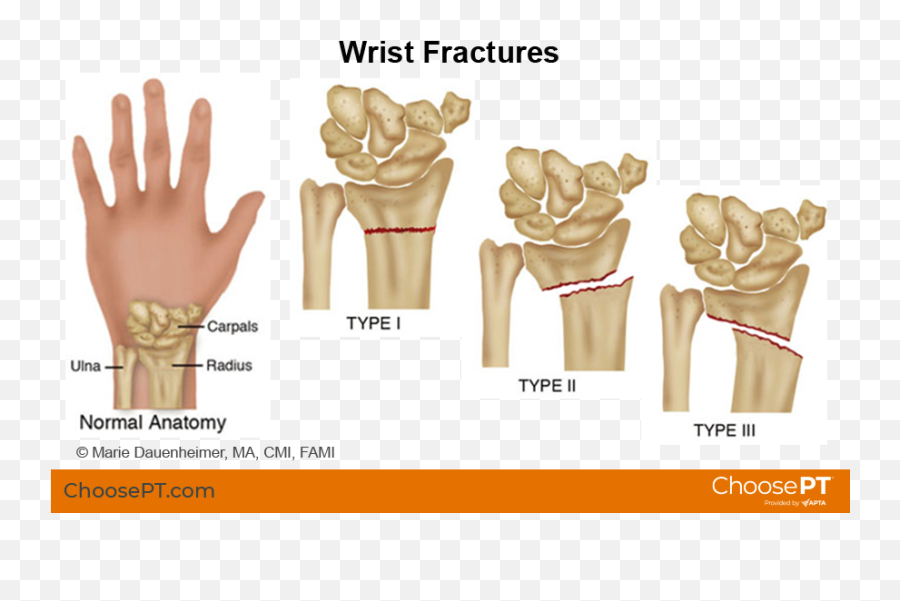 Guide Physical Therapy Guide To Wrist Fracture Choose Pt Emoji,Strong Caring Usually Entails Weaker Emotions And/or Feelings Of Caring Than Does Weak Caring True