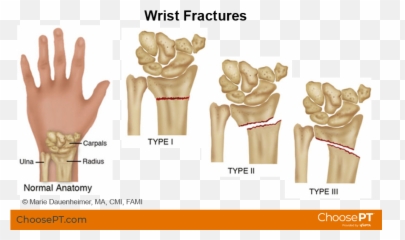 Guide Physical Therapy Guide To Wrist Fracture Choose Pt Emoji,Strong Caring Usually Entails Weaker Emotions And/or Feelings Of Caring Than Does Weak Caring True