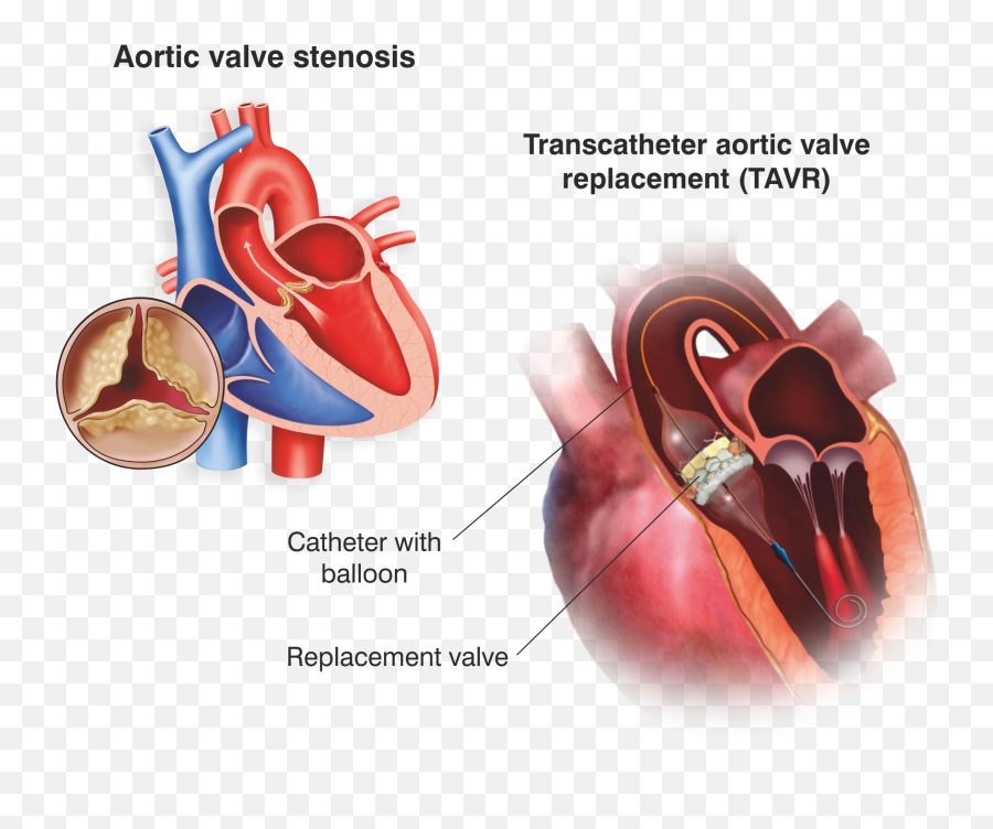 Tavr Transcatheter Aortic Valve Replacement Meril Life - Tavi Tavr Emoji,Valve Emojis Tavr Transcatheter Aortic Valve Replacement Meril Life - Tavi Tavr Emoji,Valve Emojis