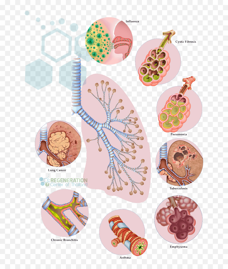 Is Lung Stem Cell Therapy For Copd Emphysema Effective - Natural Foods Emoji,Charcot Marie Tooth Emotions Reiki