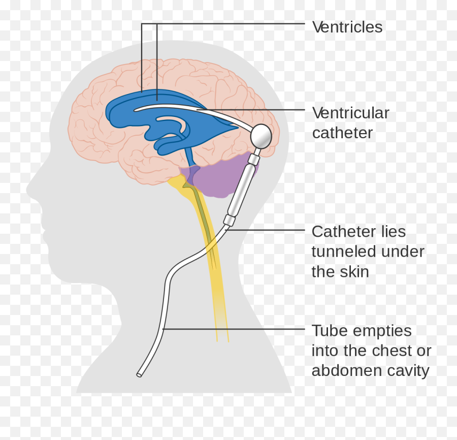 Cerebral Shunt - Wikipedia Ventriculo Caval Shunt Emoji,9 Types Of Muscle Tension Caused By Trapped Emotions