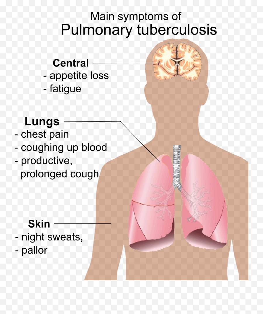 Lungs Clipart Tb Patient Lungs Tb Patient Transparent Free - Main Symptoms Of Pulmonary Tuberculosis Emoji,Tonge Emoji