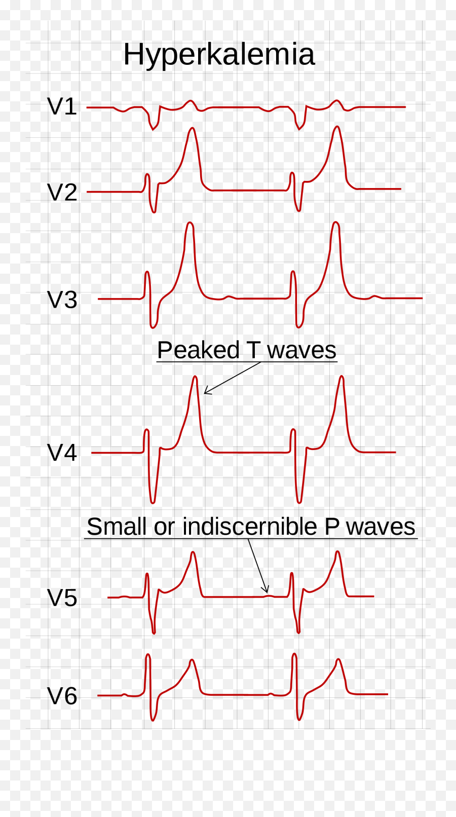 Hyperkalemia - Wikipedia Peaked T Wave Usmle Emoji,A Periodic Chart Of Human Emotion And Evaluation
