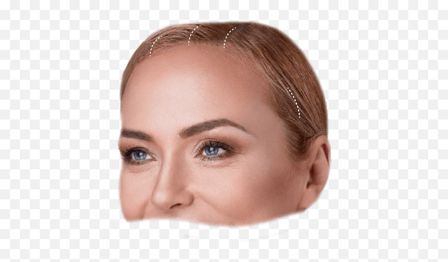 Brow Lift Visage Facial Plastic Surgery - Rhytidectomy Emoji,Facial Assymtry Of Emotion
