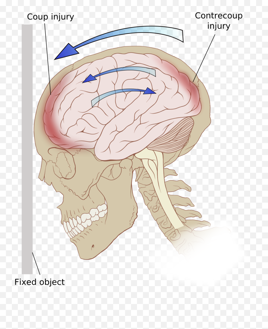 Coup Contrecoup Injury - Wikipedia Concussion Vs Tbi Emoji,Wirdbrain Emotions