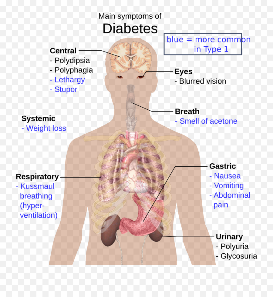 Diabetes Mellitus Types - Diabetes Meaning Emoji,Diabetes Emoticons Android
