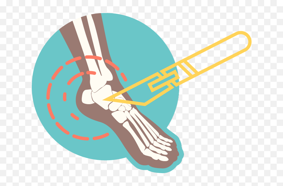Foot Ankle Procedures - Drawing Emoji,Hayward On Emotions Of Ankle Injury