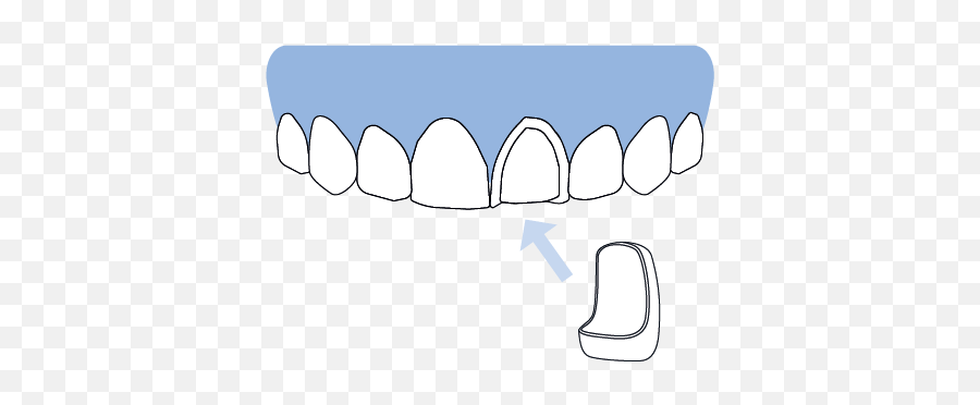 Faqu0027s U2013 Pop On Veneers Emoji,Gap Toothed Emoticon