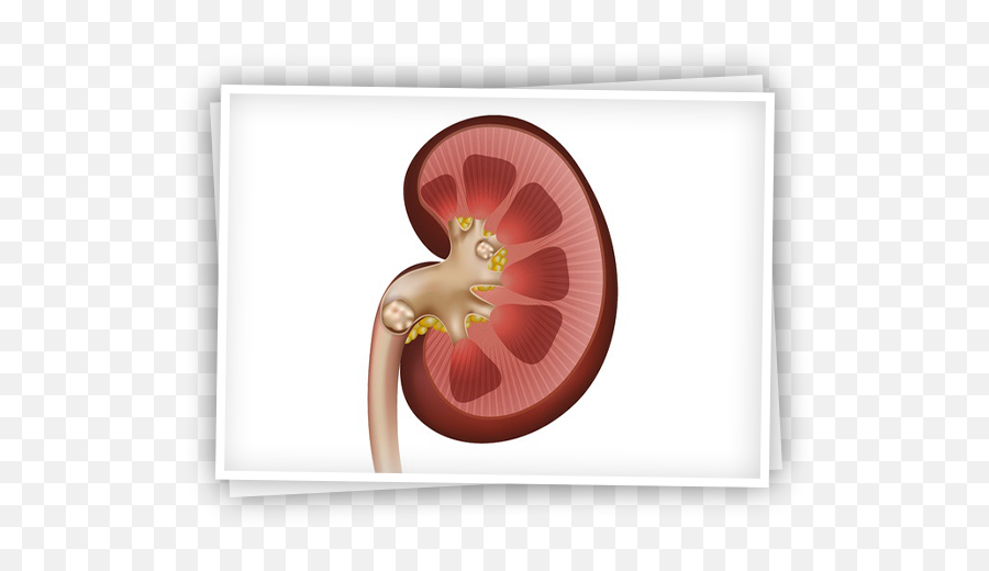 How Is Kidney Stone Treated U2013 Dr A Kadir Tepeler Md Emoji,Kidney Stone Emoji