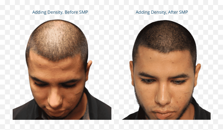 Adding Density With Scalp Micropigmentation - Hairline Ink Emoji,Less Emotions With Less Hair