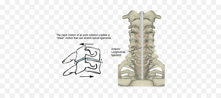 Whiplash Injury Neck Ligaments Weakened Frank E Kaden - Cervical Anterior Longitudinal Ligament Emoji,Hayward On Emotions Of Ankle Injury