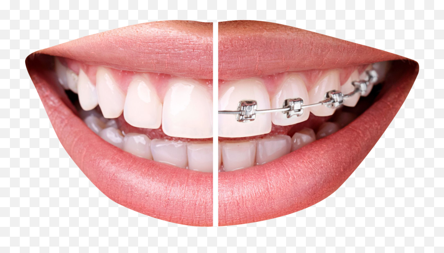Smile Mouth Transparent - Shefalitayal Teeth Braces Png Emoji,Shocked Emoji Picsart