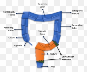 Low Anterior Resection Surgery Love - Low Anterior Resection Emoji,Emotions Of The Splenic Flexure