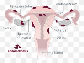 Stories Archives - Explain Endometriosis Emoji,Swirling Ocean Waves Emotions Quotes