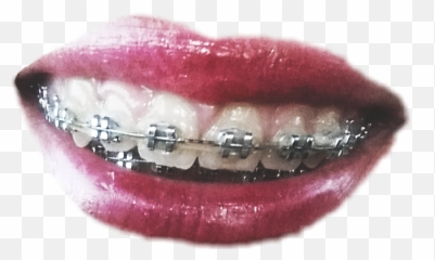 Smile Braces Lips Mouth Sticker - Oral Hygiene Emoji,Braces Smile Emoji