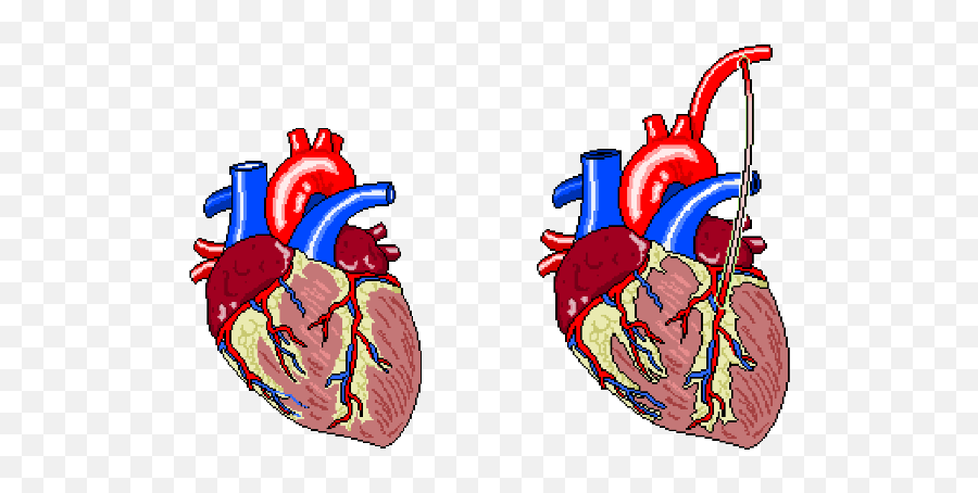 Tsp Blog - Coronary Artery Bypass Graft Cartoon Emoji,Emotions Of The Xyphoid Process