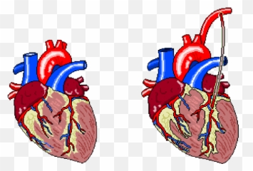 Tsp Blog - Coronary Artery Bypass Graft Cartoon Emoji,Emotions Of The Xyphoid Process
