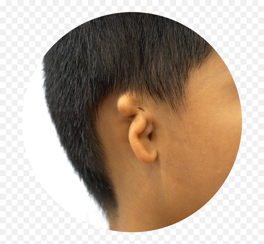 Microtia Treatment - Baby Malformed Ear Emoji,Nekomimi Emotion Ears
