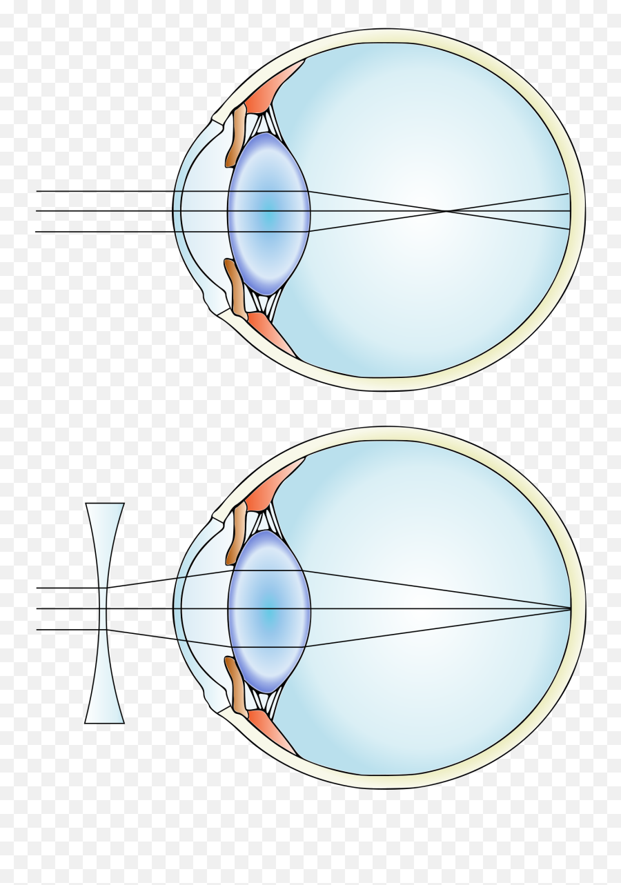 Myopia And Lens Correction - Myopia Png Emoji,Wiki Color Emotion